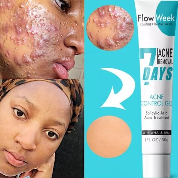 removedor-de-acne-flowweek-gel